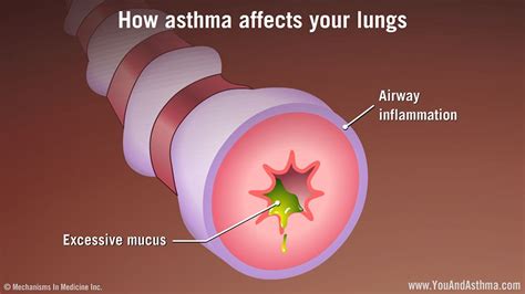 How Asthma Affects Your Lungs Asthma Inflames The Airways So They
