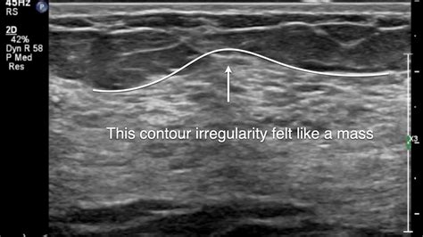 Breast Ultrasound Pronounced Glandular Tissue Youtube