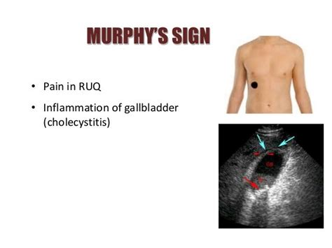 Which Side Is Gallbladder Pain