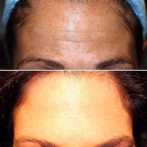 Botox Facelift Before And After Pictures 8 Facelift Info Prices