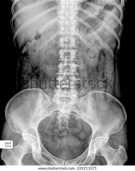 Levoscoliosis of the lumbar spine consider predisposition to lumbosacral instability. Xray Lumbosacral Spine Pelvis Inflammation Spine Stock ...