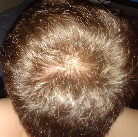 Im 17 This Is The Top Of My Head Any Tips Am I Balding Early Or