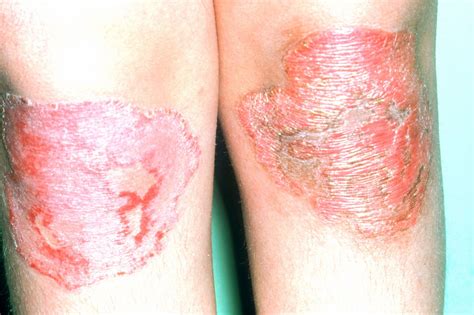 elevated mortality risk in psoriasis may be associated with comorbidities dermatology advisor