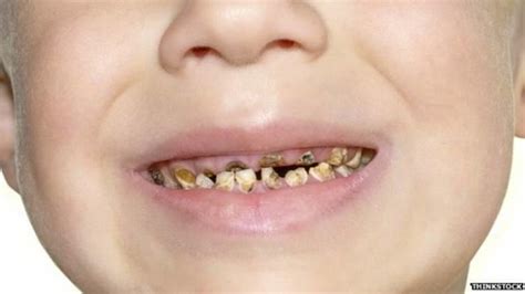 The Reasons Why Young Children Are Losing Teeth May Surprise You