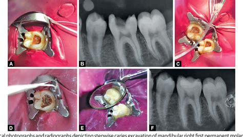 Figure 1 From Comparative Evaluation Of The Efficacy Of Stepwise Caries