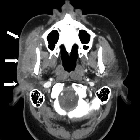 Ct Imaging Of Head And Neck Lupus Panniculitis American Journal Of