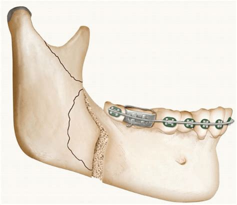 Mandibular Setback Plastic Surgery Key