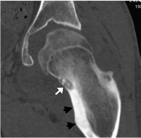 Figure 4 From Intra Articular Osteoid Osteoma In The Femoral Neck Of An
