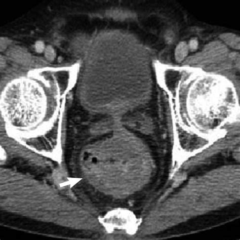 Axial Contrast Enhanced Computed Tomography Scans Showing Download