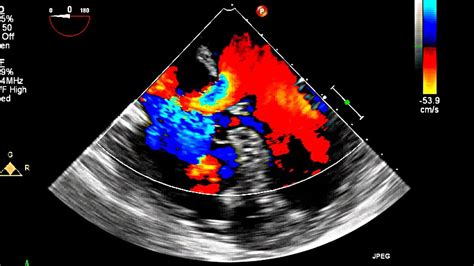 Atrial Septal Defect Primum Echocardiography Youtube