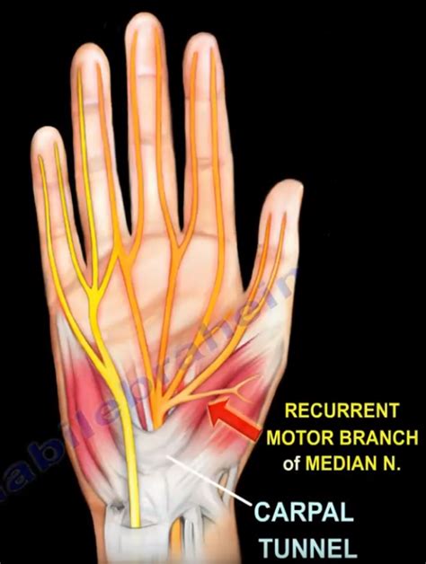 Ganglion Cyst Pressure Motor Branch Of The Median Nerve By Nabil