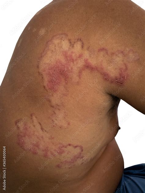 Close Up Of Back Skin Fungal Infection Tinea Corporis Stock Photo