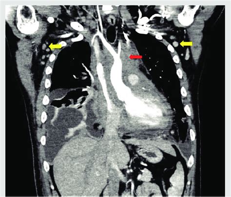 Ct Chest Large Ill Defined Soft Tissue Mass Infiltrating The