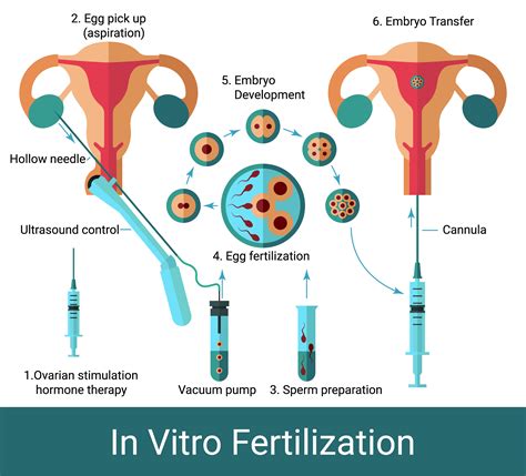 Affordable In Vitro Fertilization Ivf Treatment Cost Choosedoctor