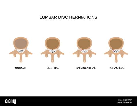 Vector Illustration Types Of Lumbar Intervertebral Disc Herniation