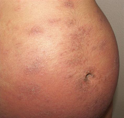 Pruritic Urticarial Papules And Plaques Of Pregnancy First Trimester