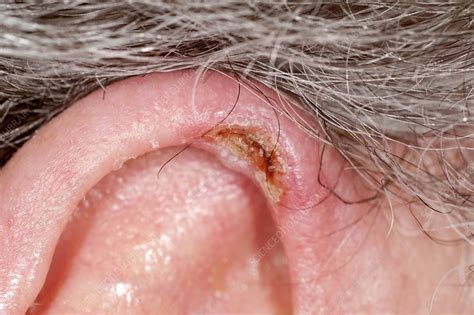 Chondrodermatitis Nodule On The Ear Stock Image C0130870 Science