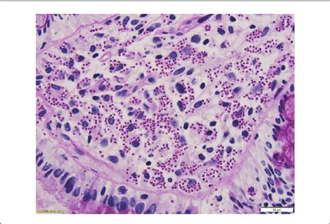 Pas Stained Rectal Biopsy Showing Abundant Histiocytes Within The