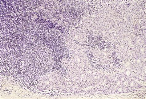Lm Of Lymph Node With Metastatic Breast Carcinoma Stock Image M132