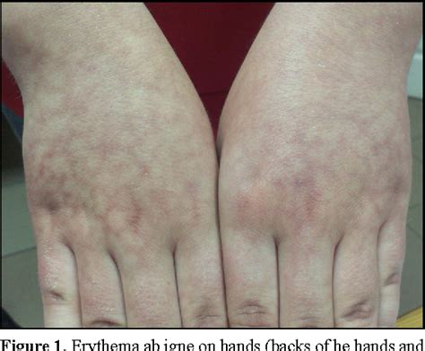 Figure 1 From Radiator Induced Erythema Ab Igne In 8 Year Old Girl