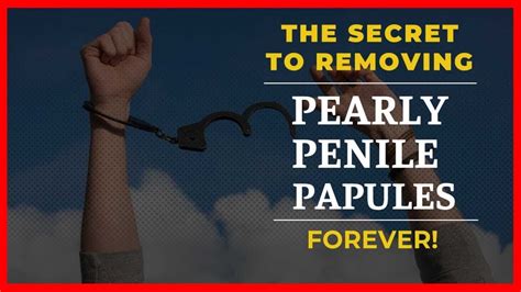 Pearly Penile Papules How To Get Rid Worry No More Youtube