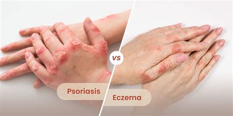 What Are The Differences Between Psoriasis And Eczema Ncert Board
