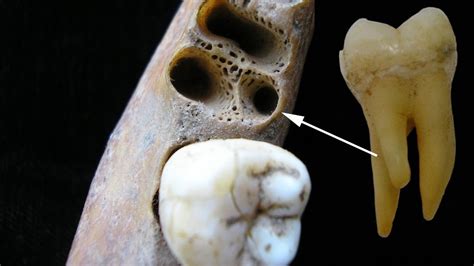 Three Rooted Molars A Rare Dental Trait Lives On