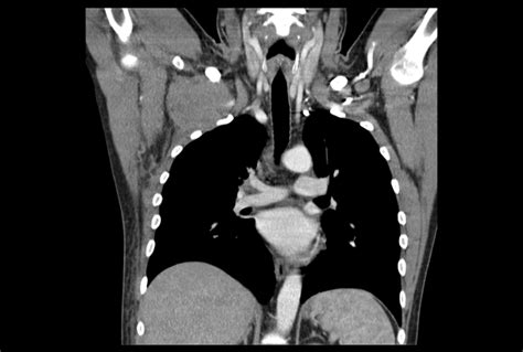 Anaplastic Large Cell Lymphoma Ct Wikidoc
