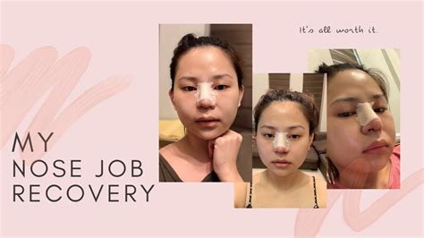 The cost of a rhinoplasty procedure ranges from $1,600 to $2,000, whilst the national average price is approximately $1,153. MY NOSE JOB RECOVERY | PHILIPPINES - YouTube