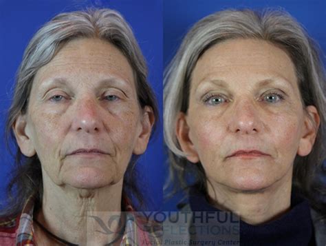 Co2 Laser Skin Resurfacing Before And After Photos Patient 31 Nashville