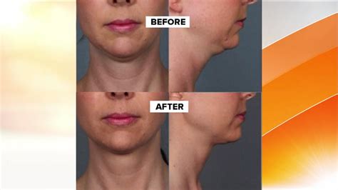 Fda Panel Recommends Approval Of Injections To Get Rid Of Double Chin