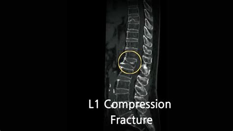 L1 First Lumbar Body Compression Fracture Causes Symptoms And
