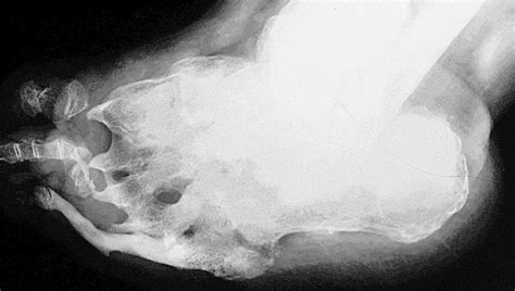 Clinical Radiograph Of Neuropathic Arthropathy Charcot Joint In An