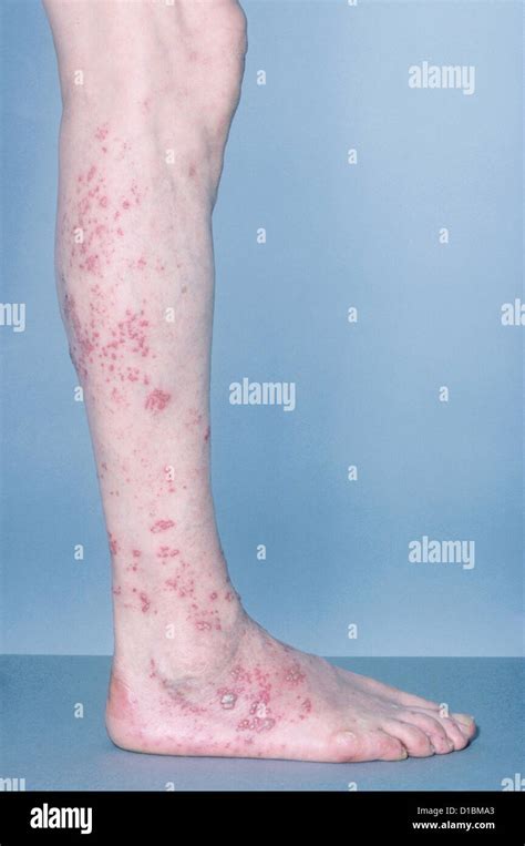 Dermatome Shingles On Leg
