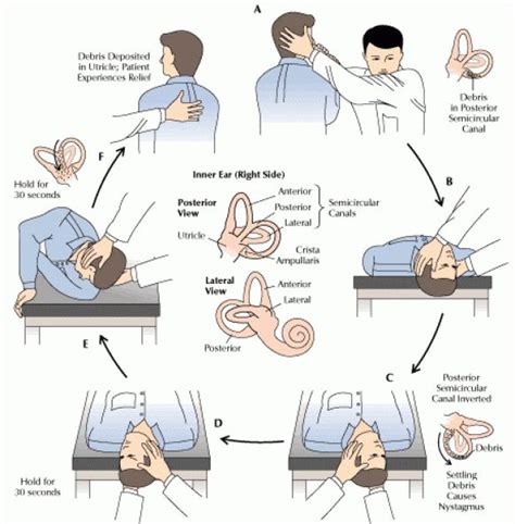 Epley Maneuver Epley Maneuver For Right Sided Posterior Semicircular Todd Kinesen