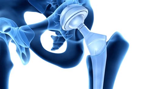 Benefits Of Hip Replacement Surgery Intellijoint Surgical