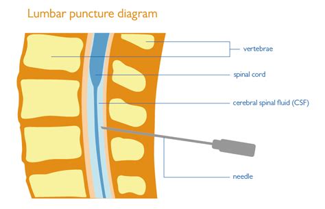 lumbar puncture fact sheet health information brain and spine foundation