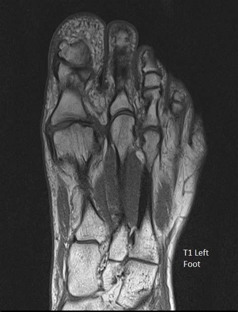 These muscles begin and attach within the skeleton of the foot, have complex anatomical and topographical and functional relationships with. MRI Scan Images | Worcestershire Imaging Centre