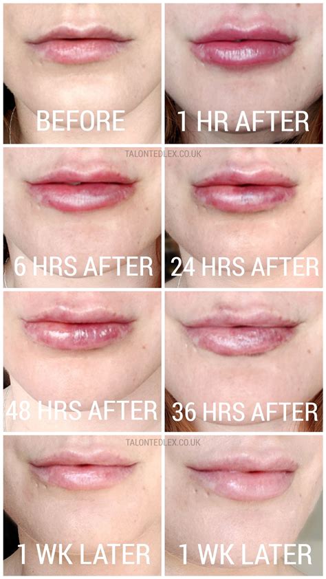 my lip fillers experience with dr pamela benito talonted lex