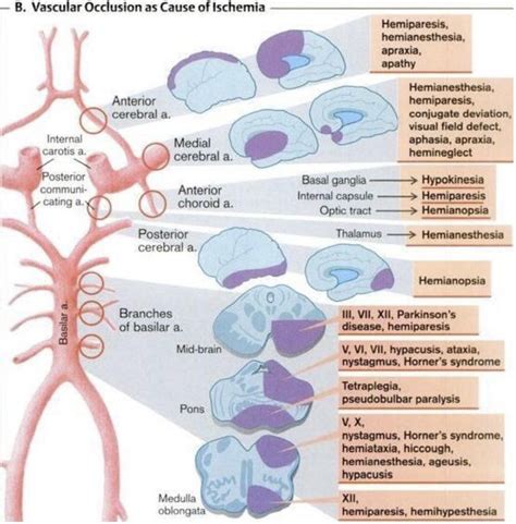 Stroke Territories And Resulting Syndromes And Effects Stroke