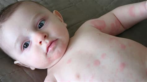 That doesn't mean you can't live with one. What are the Most Common Causes of Hives in Toddlers ...