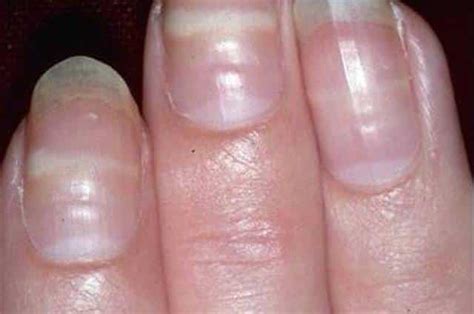 That describes beau's lines, which are the most common nail problem associated with systemic disease. Mees Lines | TreatCure