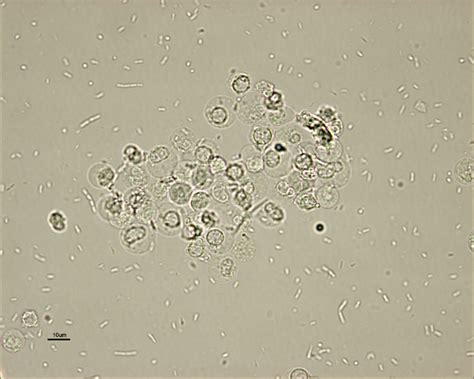 Usually, the kidneys don't allow any kind of blood cell to how to treat leukocytes in urine. leukocytes+in+urine | Managing the E coli UTI | Medical ...