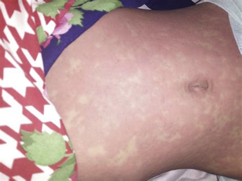 Rash With Fever In Children A Clinical Approach Paediatrics And