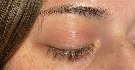 Itchy Red Inner Upper Eyelid What Is Going Onhow Do I Treat This