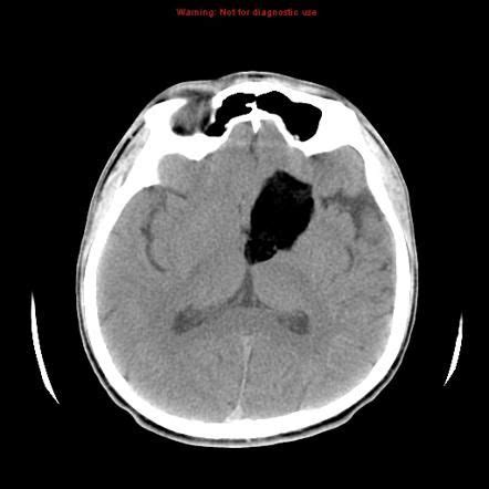 Intracranial dermoid cyst | Radiology Reference Article ...