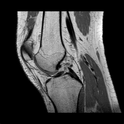 Knee Muscle Anatomy Mri Knee Dislocation Wikipedia