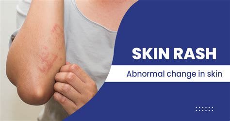 Skin Rash Types Causes Tests And More