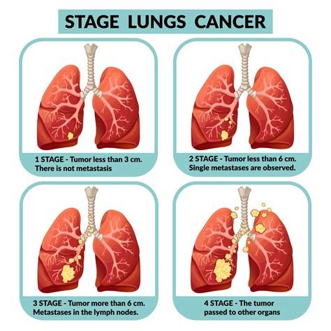 What Is The Best Treatment For Lung Cancer Stage 4 By Mayur Raval