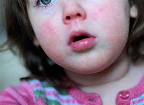 Baby Pimples On Face 1 Year Old Goimages Cove